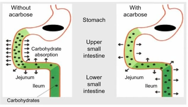 Acarbose acts